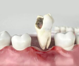 CAVITY