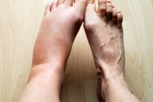 Swollen feet ankle Small